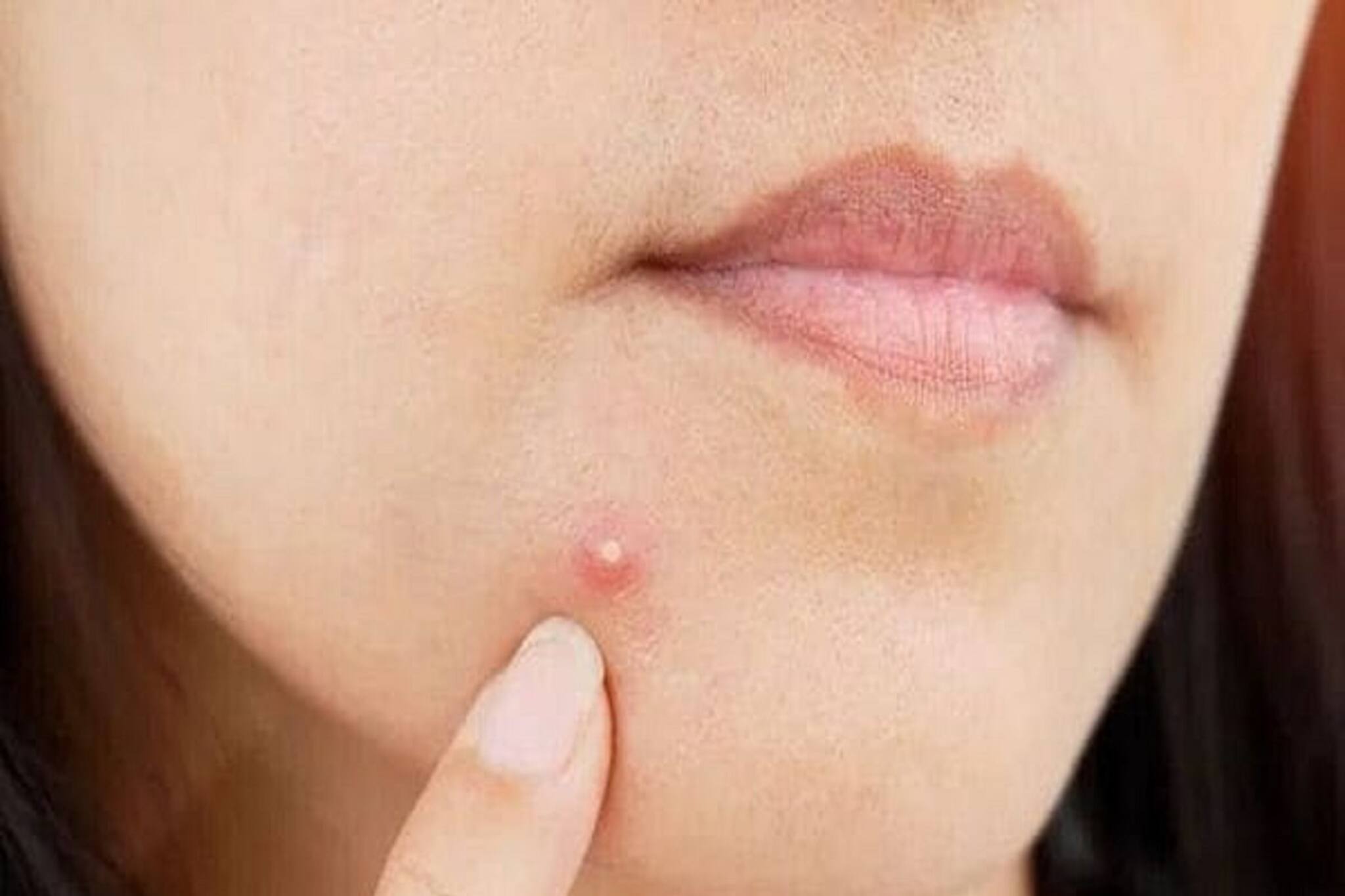 ফোঁড়ার ব্যথায় কাবু! বাড়িতেই করুন এই সহজ কাজ! দু'দিনে গায়েব হবে!