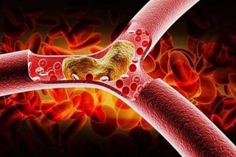 এটি সহজে ধরা পড়েনা এরজন্য লিপিড প্রোফাইল পরীক্ষা করাটা অত্যন্ত গুরুত্বপূর্ণ ৷ শরীরের তিন অংশে ব্যথা বা যন্ত্রণা হলে রক্তপরীক্ষা আবশ্যিক ৷ প্রতীকী ছবি ৷ 