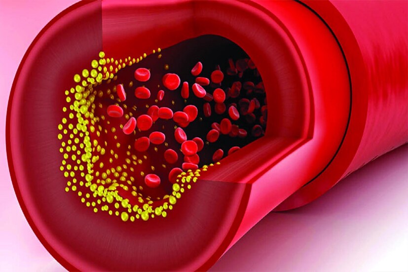 শরীরে কোলেস্টেরলের স্তর বাড়তে থাকে ৷ ধমনী ব্লক হয়ে যায় ৷ যাতে রক্ত হৃদয় পর্যন্ত পৌঁছতে অত্যন্ত সময় লাগে ৷ প্রতীকী ছবি ৷ 