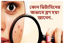 কোন ভিটামিনের অভাবে ব্রণ হয় জানেন? একটু সতর্ক হলেই এড়াতে পারেন সমস্যা