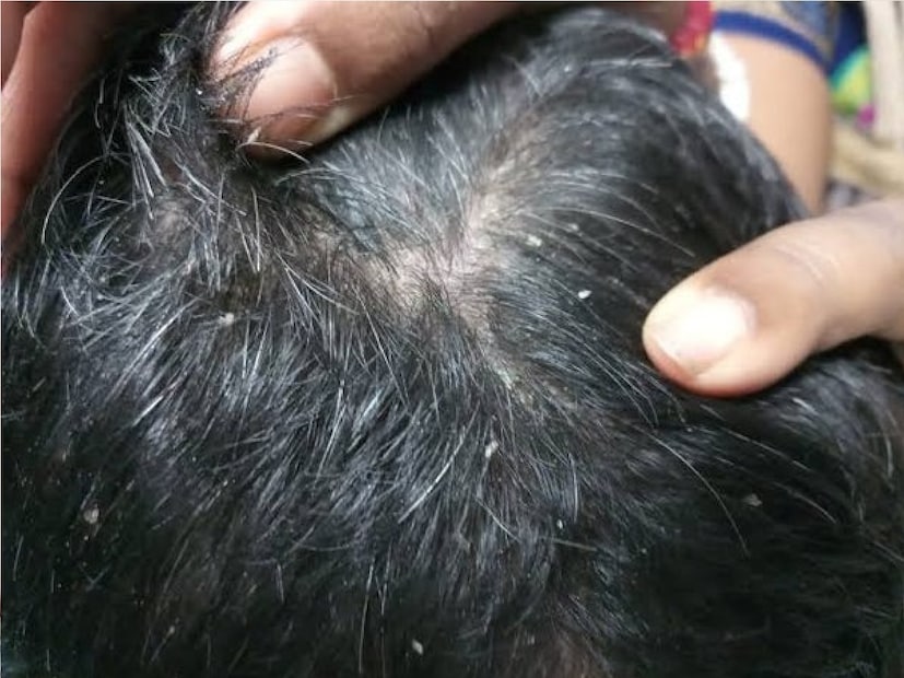 *একটি মিশরীয় মমির মাথায়ও উকুন পাওয়া গিয়েছে। লাইভ সায়েন্সের প্রতিবেদনে বলা হয়েছে, একটি প্রাচীন মিশরীয় মমির মাথায়ও উকুন পাওয়া গিয়েছে। বাইবেল এবং গ্রিক সাহিত্যেও তার উল্লেখ রয়েছে। সংগৃহীত ছবি। 