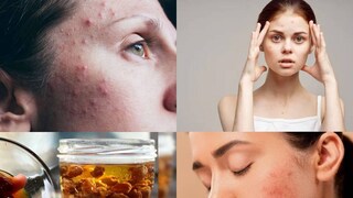 ব্রণ, অ্যাকনে সারাতে হাজারো টোটকার কথা শোনা যায়