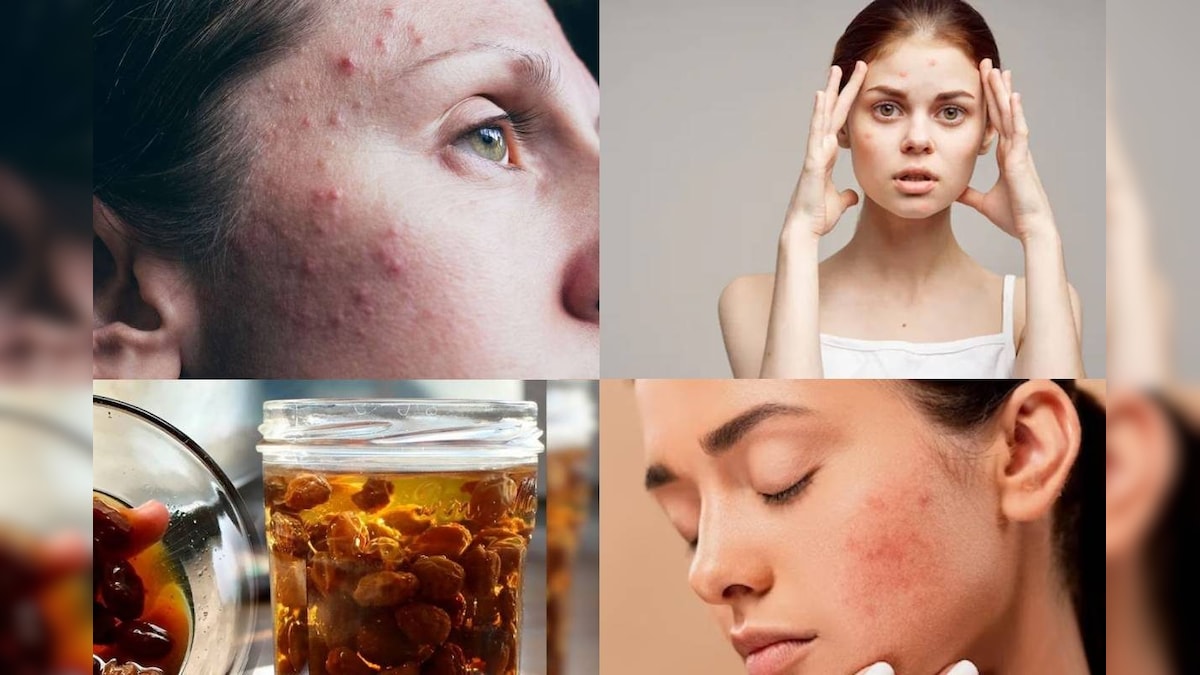 Home Remedy for Pimples: সকালে খালি পেটে খান এই ফল ভেজানো জল, ব্রণ এবং ...