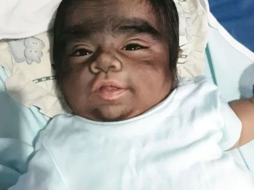 তবে শিশুটির মায়ের বিশ্বাস তিনি সন্তান গর্ভাবস্থায় থাকাকালীন বেড়ালের মাংস খেয়েছিলেন৷ তাঁর ধারণা তিনি বেড়ালের মাংস খাওয়ার কারণেই তাঁর ছোট্ট শিশুর গায়ে এই ধরণের লোম হয়ে যায়৷ ঘটনাটি ঘটেছে ফিলিপাইনের আপ্পায়িও প্রদেশে৷ 