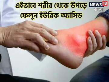 সহজেই পাবেন এই ৫ জিনিস, আয়ুর্বেদেই বশ হবে শরীরে ইউরিক অ্যাসিডের দংশন
