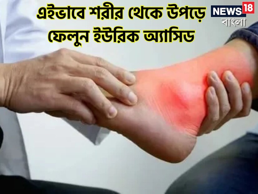 ইউরিক অ্যাসিড রক্তে পাওয়া একটি বর্জ্য পদার্থ। শরীরের মধ্যে পিউরিন নামক একটি গুরুত্বপূর্ণ রাসায়নিক ভেঙে গেলে এটি নির্গত হয়। অতিরিক্ত ইউরিক অ্যাসিড সাধারণত রক্তে মিশ্রিত হয়ে যায় যা কিডনির মধ্য প্রবেশ করে৷ পাশাপাশি তা প্রস্রাবের মাধ্যমে শরীর থেকে বাইরে নিঃসৃত হয়৷  শরীরে অত্যধিক ইউরিক অ্যাসিড নিঃসরণের ফলে গেঁটেবাত, কিডনিতে স্টোনের মতো মারাত্মক রোগ হতে পারে৷ পাশাপাশি নখের কোনে ব্যাথার মতো ঘিনঘিনে অসহ্য বিষয়টিও ইউরিক অ্যাসিডের কারণে হতে পারে৷