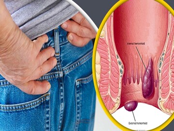 পাইলস-এর অসহ্য যন্ত্রণা? ঘুরিয়ে-ফিরিয়ে খান এই খাবারগুলো,পাইলস পালানোর পথ পাবে না