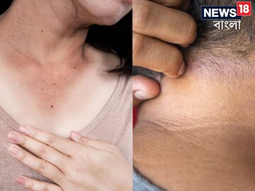 ছোপ ছোপ 'পিগমেন্ট' গলায়-ঘাড়ে..? কালো পোঁচ পোঁচ দাগ? এই 'ফার্মেসি ক্রিম' অব্যর্থ!