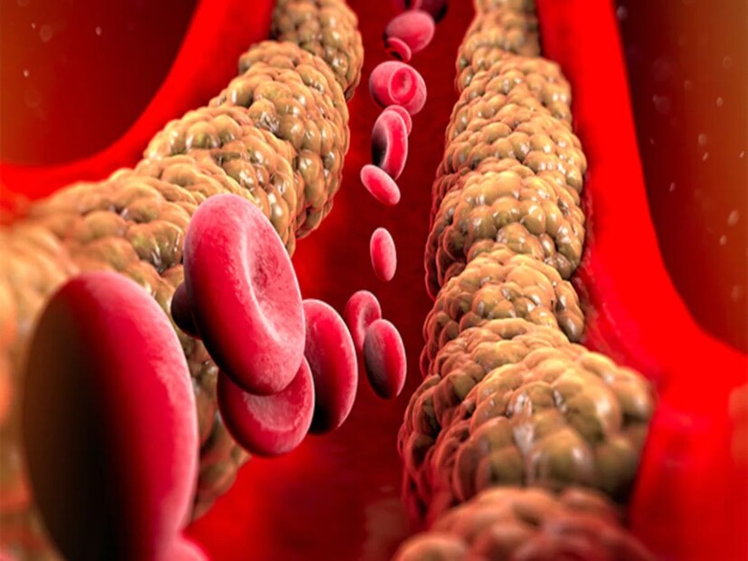 শরীরে উপস্থিত কোলেস্টেরল হল মোমের মতো দেখতে একধরণের ফ্যাট। এটি দুই ধরনের - নিম্ন ঘনত্বের লাইপোপ্রোটিন (LDL) এবং উচ্চ ঘনত্বের লাইপোপ্রোটিন (HDL)। বিশেষজ্ঞদের মতে, রক্তে এলডিএলের পরিমাণ বেশি হলে রক্তের ধমনীতে চর্বি জমা বেড়ে যায়, যাকে প্লেক বলে। শরীরে উপস্থিত কোলেস্টেরল হল মোমের মতো দেখতে একধরণের ফ্যাট। এটি দুই ধরনের - নিম্ন ঘনত্বের লাইপোপ্রোটিন (LDL) এবং উচ্চ ঘনত্বের লাইপোপ্রোটিন (HDL)। বিশেষজ্ঞদের মতে, রক্তে এলডিএলের পরিমাণ বেশি হলে রক্তের ধমনীতে চর্বি জমা বেড়ে যায়, যাকে প্লেক বলে।