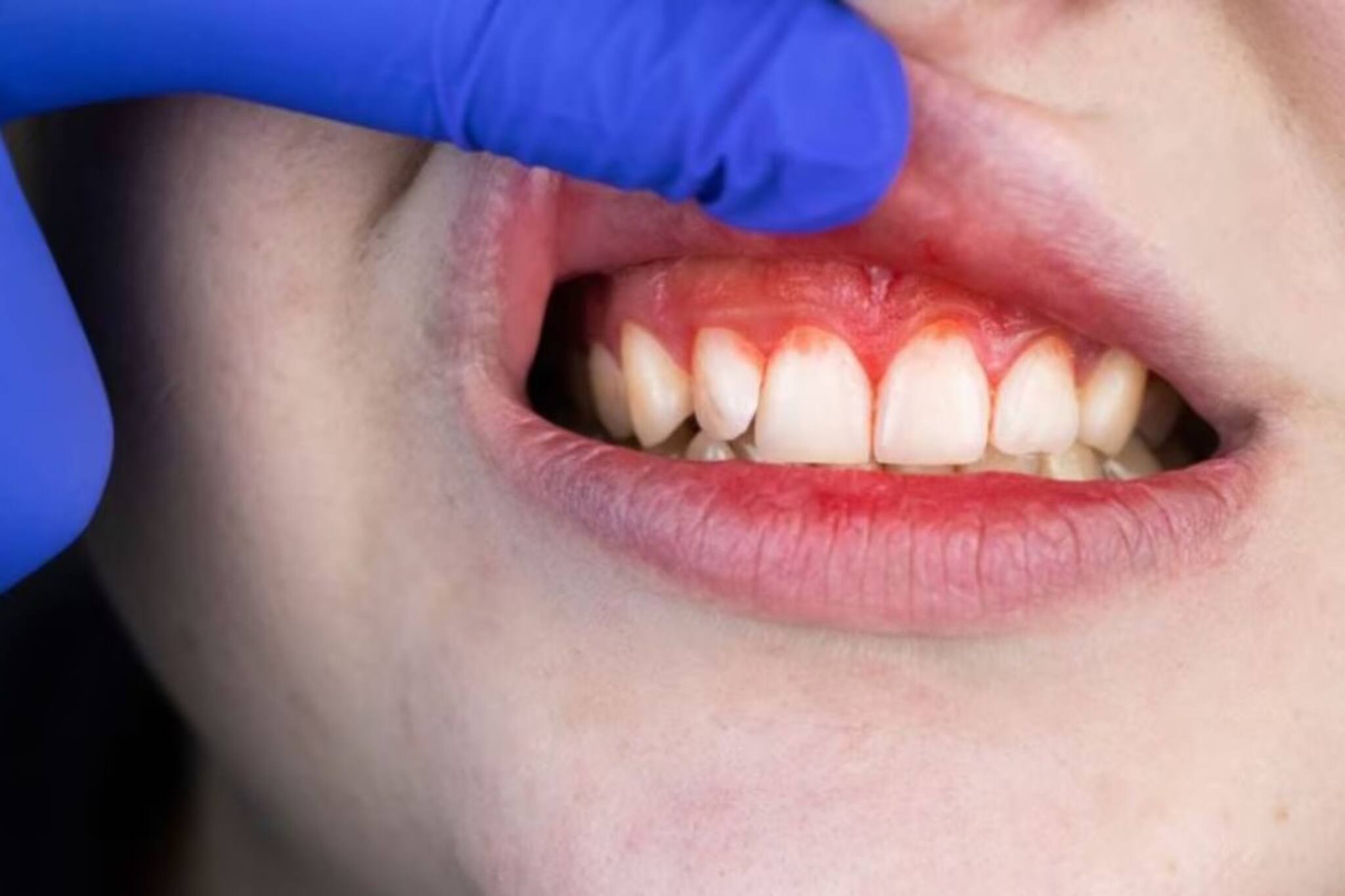 দাঁত দিয়ে গড়িয়ে পড়ছে রক্ত? মারাত্মক ক্ষতি