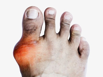 বয়স অনুযায়ী ইউরিক অ্যাসিড 'কত' হলে পারফেক্ট? জানুন নরম্যাল লেভেল! দেখুন চার্ট বয়স অনুযায়ী ইউরিক অ্যাসিড 'কত' হলে পারফেক্ট? জানুন নরম্যাল লেভেল! দেখুন চার্ট