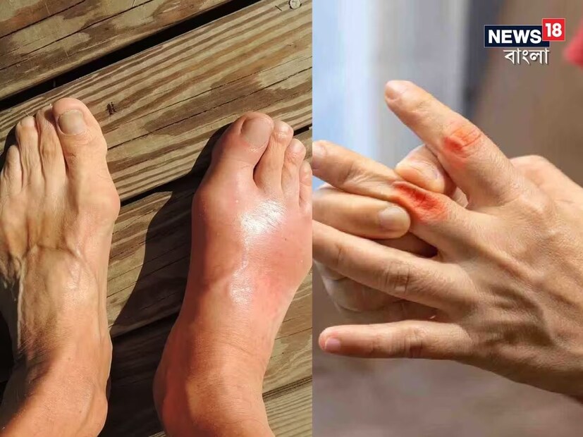 কিছু গবেষণায় দেখা গিয়েছে, এটি উচ্চ রক্তচাপ, হৃদযন্ত্রের ব্যর্থতা, বিপাকীয় সিন্ড্রোমের সঙ্গে যুক্ত। এগুলি এমন কিছু কারণ যা একজন ব্যক্তির ডায়াবেটিস এবং স্ট্রোকের সম্ভাবনা বাড়ায়। তাই ইউরিক অ‍্যাসিডকে নিয়ন্ত্রণে রাখা দরকার। 