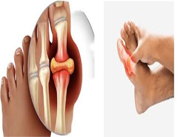 তরতরিয়ে নামবে Uric Acid! এই 'দুই সস্তার ভেষজ' ম্যাজিকের মতো কমাবে শরীরের ফোলা, ব