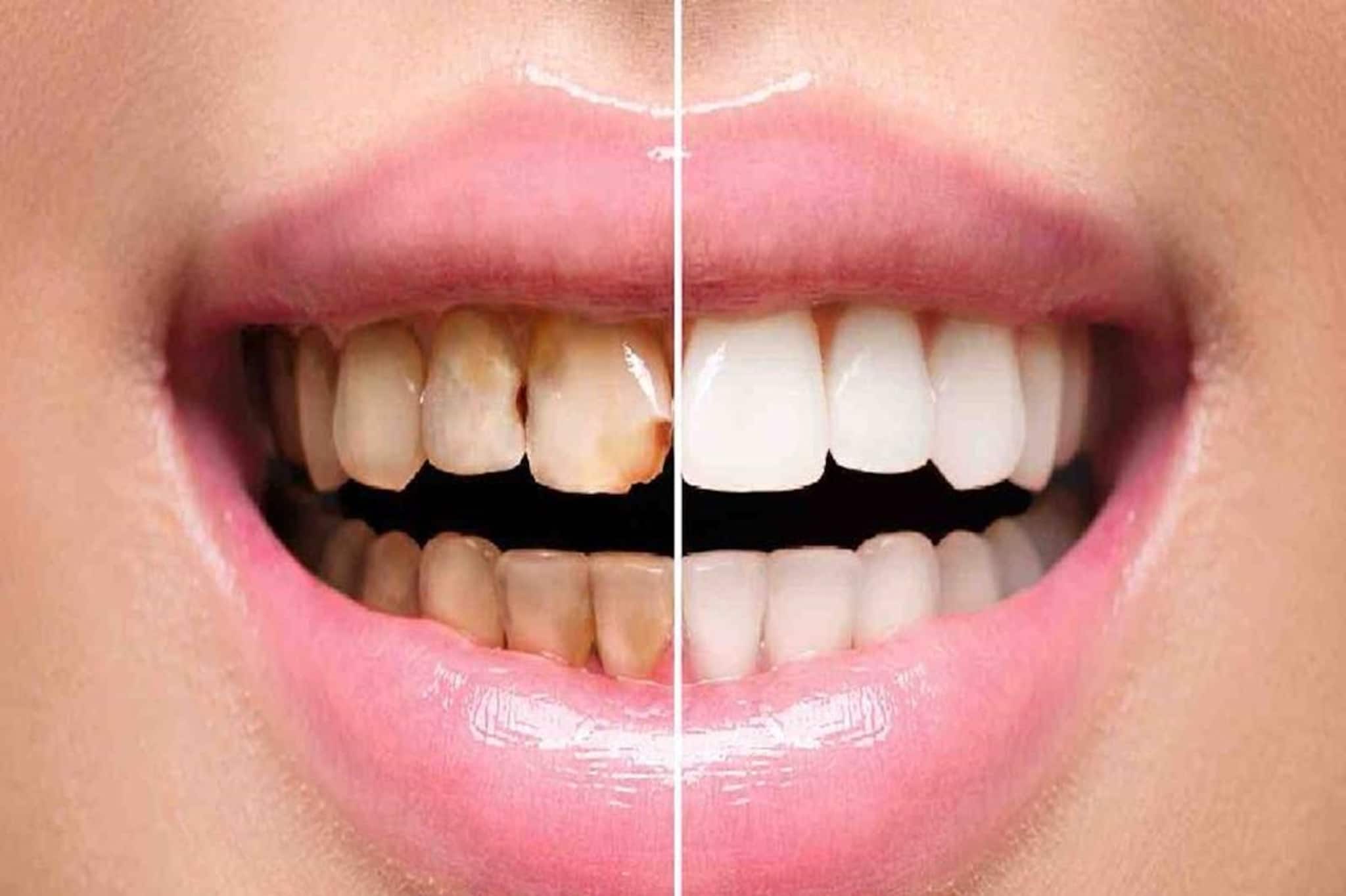 আপনার রান্নাঘরেই আছে এই ব্রহ্মাস্ত্র! নিয়ম মেনে ব্যবহার করলেই দূর হবে ক্যাভিটি সমস্যা...