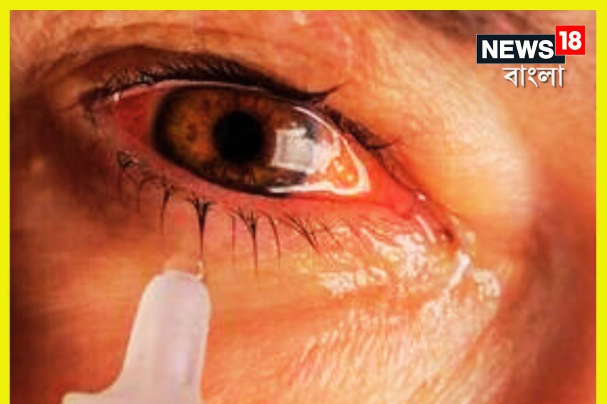 ব্যথায় চারিদিক অন্ধকার, কনজাংটিভাইটিস সারবে ছোট ছোট পাঁচটি ঘরোয়া টোটকায়