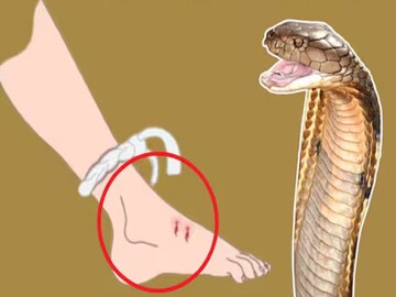 বিষাক্ত সাপের ছোবল! সঙ্গে সঙ্গে কী করা উচিত? কীভাবে কমাতে পারেন বিষের প্রভাব