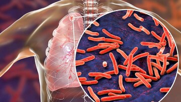 ‌যক্ষ্মা