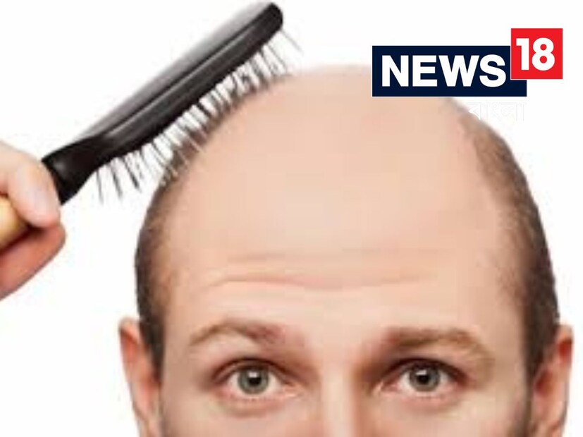 Hair Loss Reasons: এই ৫ খারাপ অভ্যাস দূর না করলে আপনারাই ক্ষতি! সাবধান, অল্প বয়সেই মাথায় দেখা দেবে বিরাট টাক…