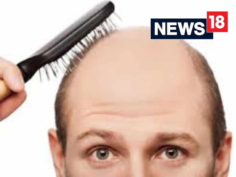 Hair Loss Reasons: এই ৫ খারাপ অভ্যাস দূর না করলে আপনারাই ক্ষতি! সাবধান, অল্প বয়সেই মাথায় দেখা দেবে বিরাট টাক… Hair Loss Reasons: এই ৫ খারাপ অভ্যাস দূর না করলে আপনারাই ক্ষতি! সাবধান, অল্প বয়সেই মাথায় দেখা দেবে বিরাট টাক…