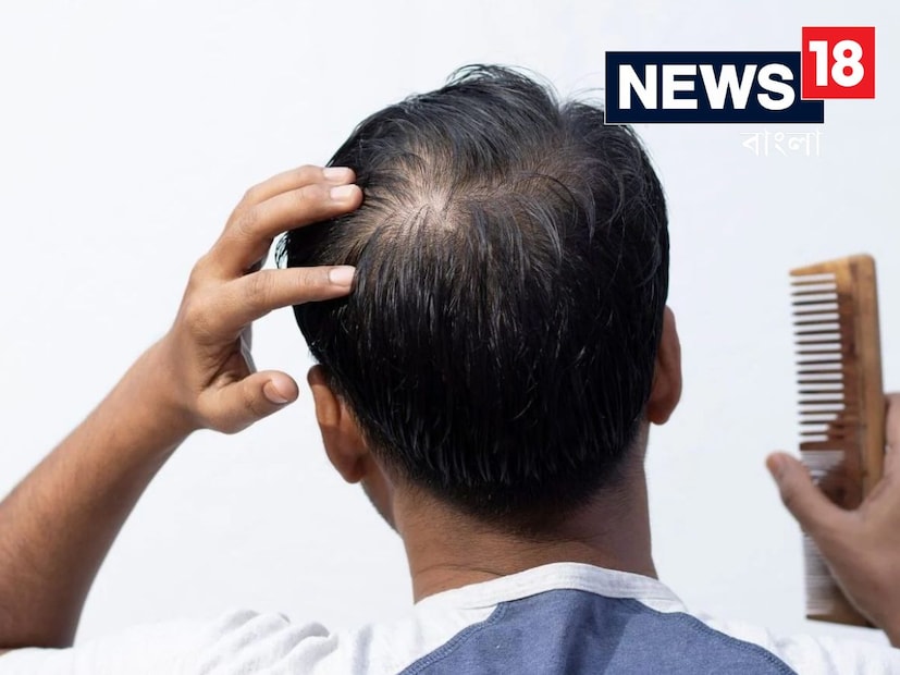 পুষ্টির ঘাটতি: আমাদের চুলের বৃদ্ধির জন্য পর্যাপ্ত পুষ্টি প্রয়োজন। যদি খাদ্যাভ্যাসে আয়রন, প্রোটিন, বায়োটিন, ভিটামিন-ডি ও জিঙ্কের ঘাটতি হয়, তাহলে সরাসরি চুল দুর্বল হয়ে পড়ে। বিশেষ করে যারা ক্র্যাশ ডায়েটিং করেন বা অনিয়মিত খাদ্য খান, তাদের মধ্যে এই সমস্যা বেশি দেখা যায়।