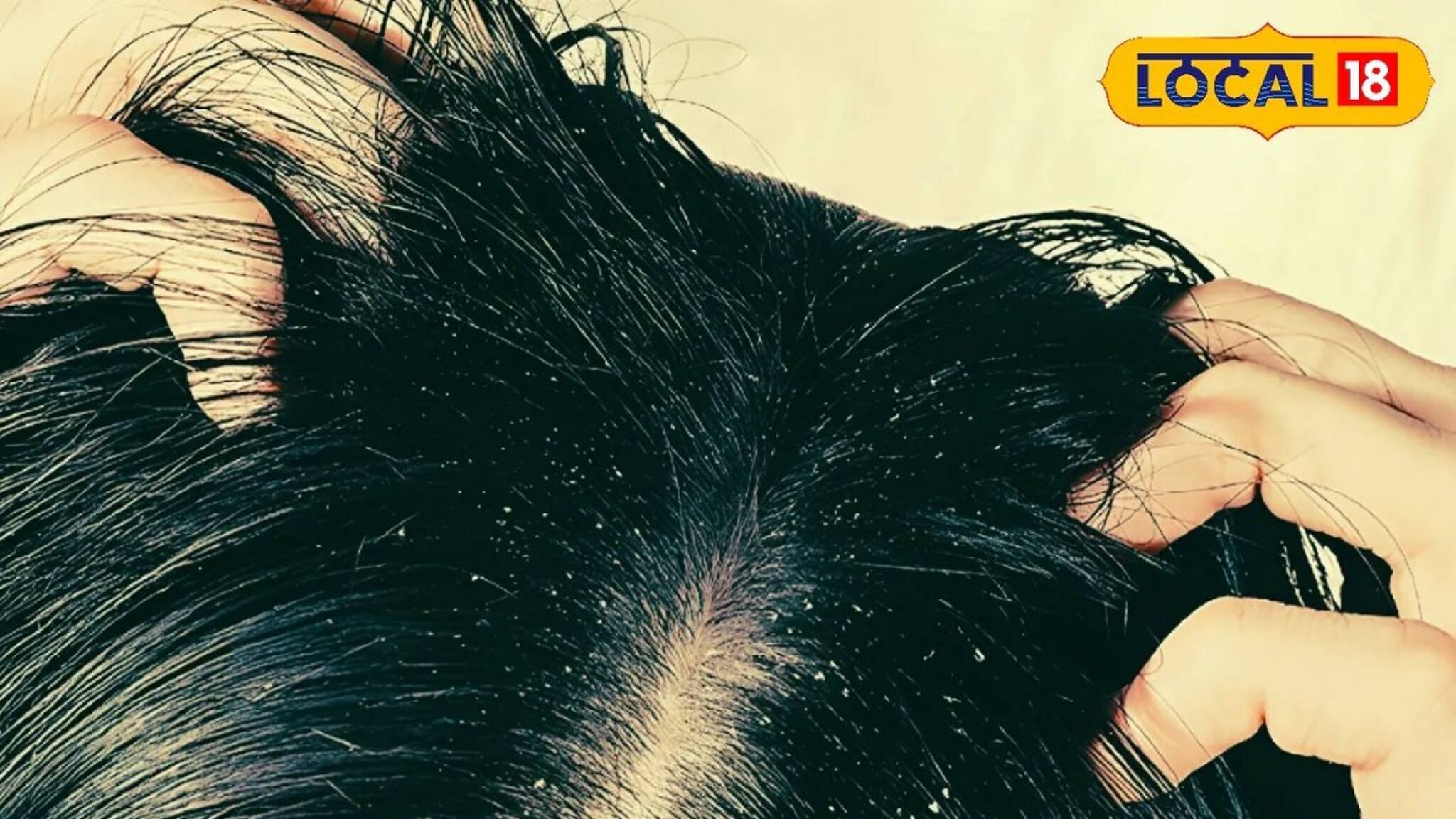Dandruff Problem: মাথায় দলা দলা খুশকি ভরে যাচ্ছে? নামী-দামি শ্যাম্পু না, ভরসা রাখুন এই 'একটি' জিনিসে! জানুন ডাক্তারের পরামর্শ
