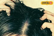 চুলে দলা দলা খুশকি? নামী-দামি শ্যাম্পু না, ম্যাজিক 'একটি' জিনিসে! ডাক্তারের মত
