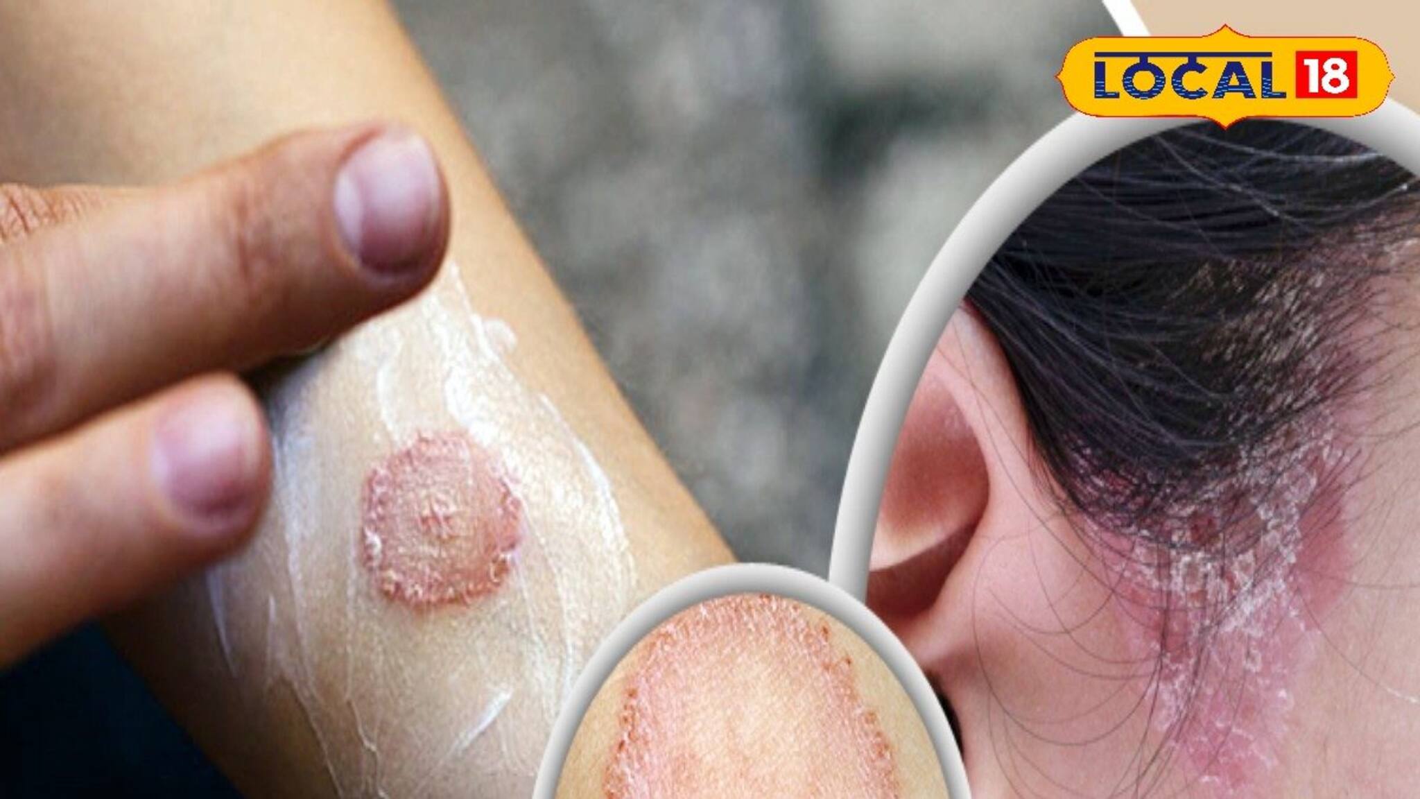 দাদ-চুলকানিতে নাজেহাল? ওষুধ নয়, এই সহজ ঘরোয়া উপায়ে ২ দিনে পাবেন মুক্তি