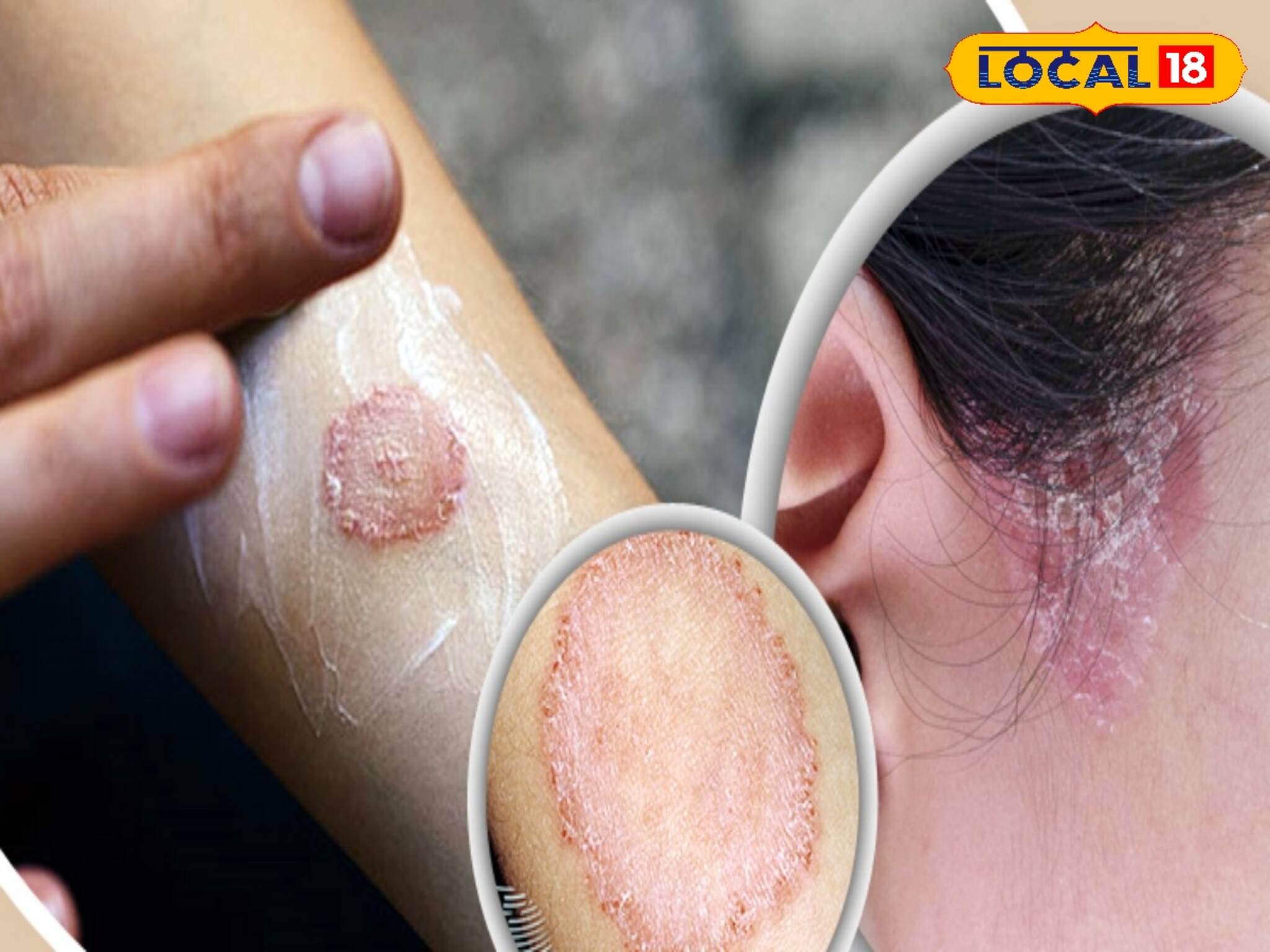 দাদ-চুলকানিতে নাজেহাল? ওষুধ নয়, এই সহজ ঘরোয়া উপায়ে ২ দিনে পাবেন মুক্তি