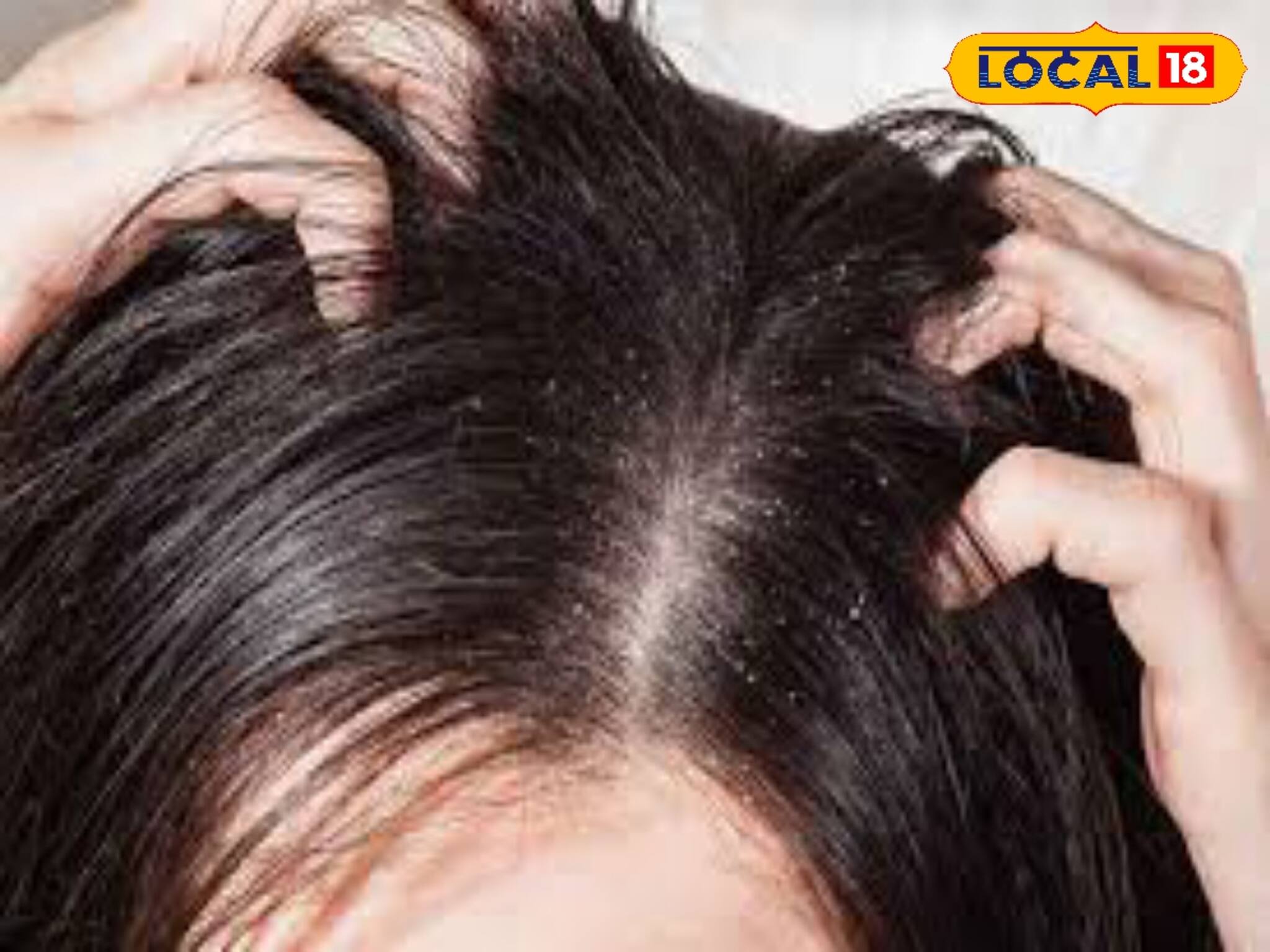 শীতকাল এলেই খুসকির সমস্যা! ঘরোয়া উপায়ে পাকাপাকি ভাবে দূর হবে খুসকি! জানুন