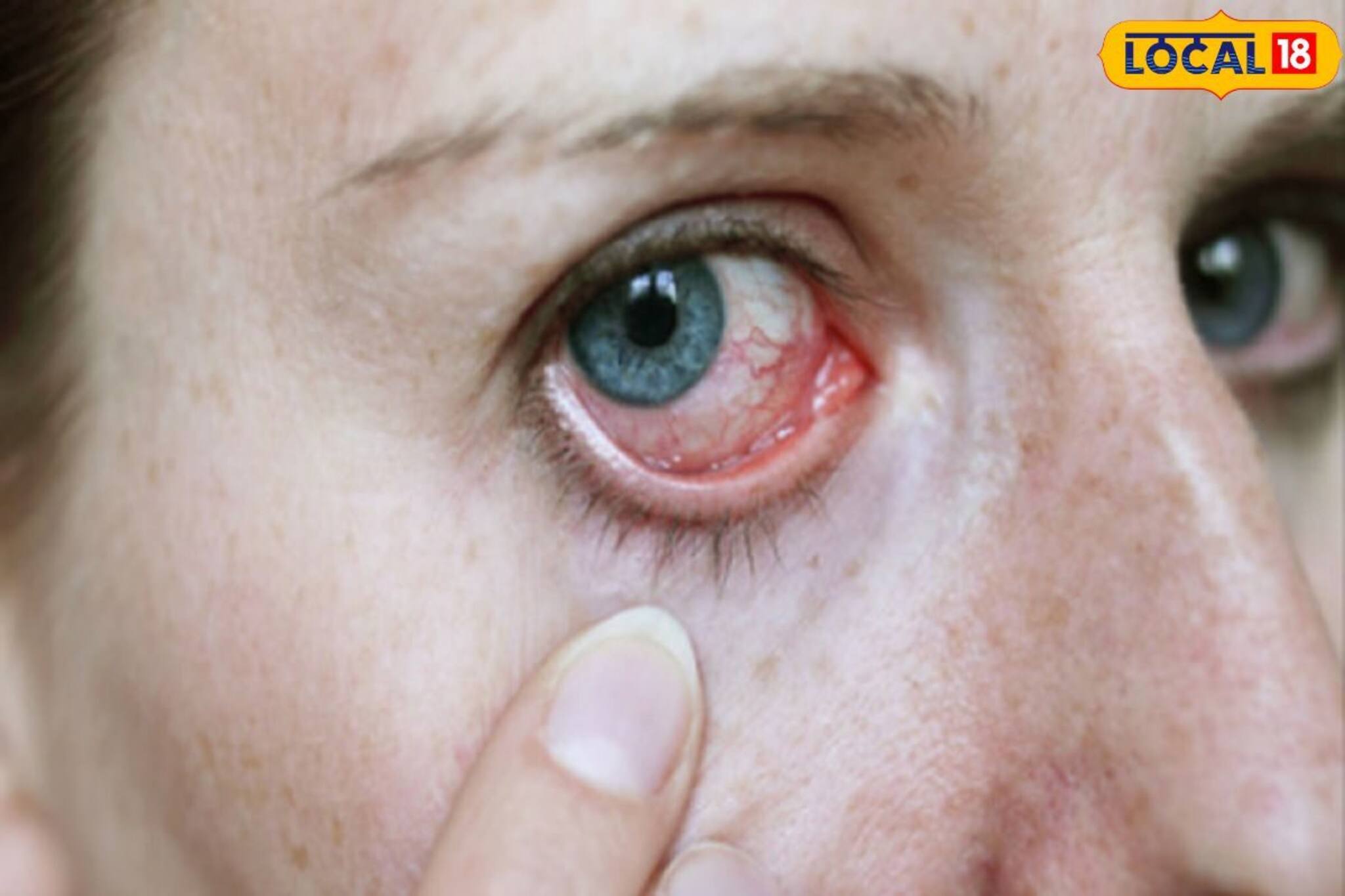 চোখ টেনে দেখুন, আপনারও কি এমন হয়? এই লক্ষণ থাকলে সাবধান হোন, জানুন ডাক্তারের মত