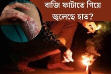 কেউ বলে টুথপেস্ট, কারও মতে বরফ...বাজি ফাটাতে গিয়ে হাত পুড়লে ঠিক কী করা উচিত?