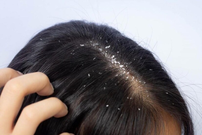 খুশকি থেকে রেহাই পেতে বাজারে নানা ধরনের শ্যাম্পু ও লোশন পাওয়া যায়। কিন্তু সেগুলিতে থাকা বিভিন্ন রাসায়নিক উপাদানের প্রভাবের চুল ঝড়েও পড়ে। এই খুশকি সমস্যা থেকে বাঁচতে মেনে চলুন এই কিছু টিপস । (তথ্য-পিয়া গুপ্তা)