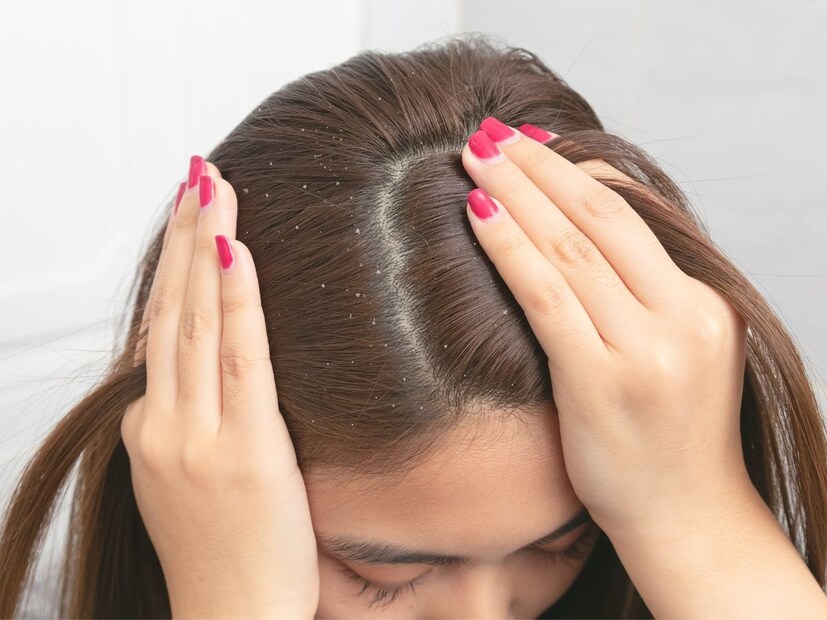 বিউটি এক্সপার্ট সঙ্গীত গুহ রায় জানান, খুশকির সমস্যা থেকে মুক্তি পেতে ব্যবহার করতে পারেন নারকেল তেল। খুশকির প্রকোপ কমাতে খুবই কার্যকরী নারকেল তেল। সপ্তাহে দু’বার চুলের গোড়ায় নারকেল তেলের মালিশ করলে দ্রুত উপকার পাওয়া যায়। (তথ্য-পিয়া গুপ্তা)