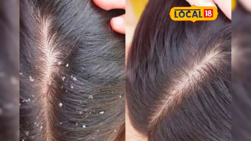 এছাড়াও খুসকি দূর করতে আপনি চুলে ব্যবহার করতে পারবেন লেবুর রস অল্প জলের সঙ্গে মিশিয়ে মাথার ত্বকে ভালভাবে ম্যাসাজ করুন। ২-৫ মিনিট ম্যাসাজ করার পর চুল ধুয়ে নিন। সপ্তাহে দু’বার এইভাবে চুলে লেবু ব্যবহার করুন। (তথ্য-পিয়া গুপ্তা)