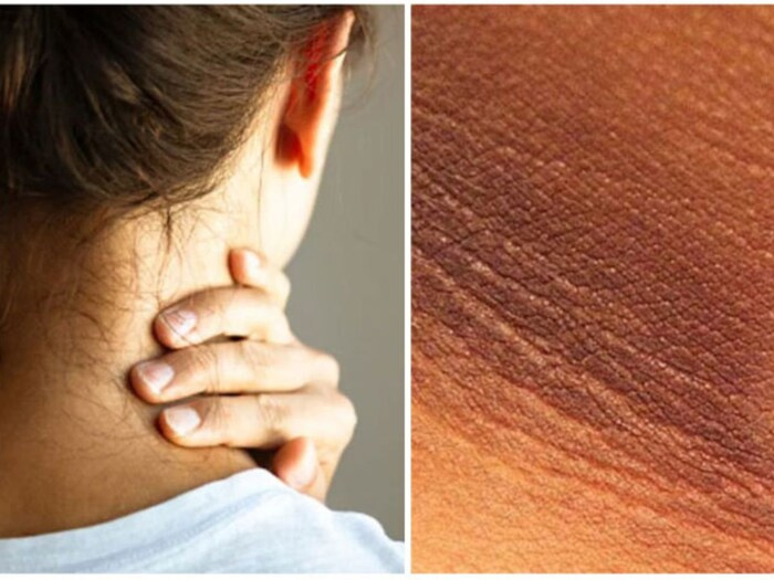 Dark spots on Neck and Elbows ছোপ ছোপ দাগ গলাঘাড়কনুইয়ে...? পুরু