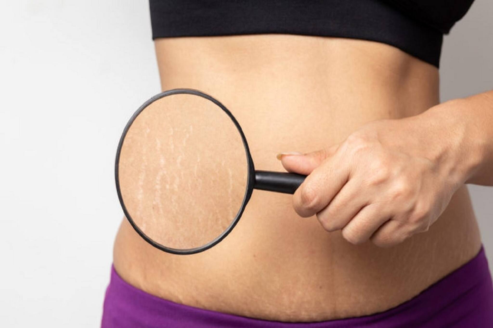 স্ট্রেচ মার্কের সমস্যায় জেরবার? রান্নাঘরেই রয়েছে এর সমাধান, রইল ম্যাজিক টিপস