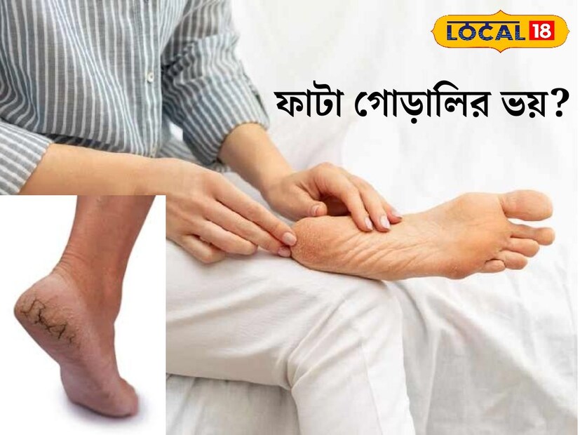 পা ফাটার সমস্যা নতুন নয়। কমবেশি সকলেই কোনও না কোনও বয়সে এই সমস্যার মুখোমুখি হয়ে থাকেন। বিশেষ করে শীতকালে পা ফাটার লক্ষণ বেশি দেখা যায়। এই ফাটা থেকে মুক্তি পেতে পারেন আপনিও। খুব সহজ কয়েকটি ঘরোয়া উপায়ে।