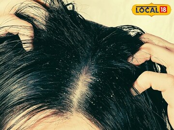 দলা দলা খুশকি ভরে যাচ্ছে? নামী-দামি শ্যাম্পু না, ভরসা রাখুন এই 'একটি' জিনিসে