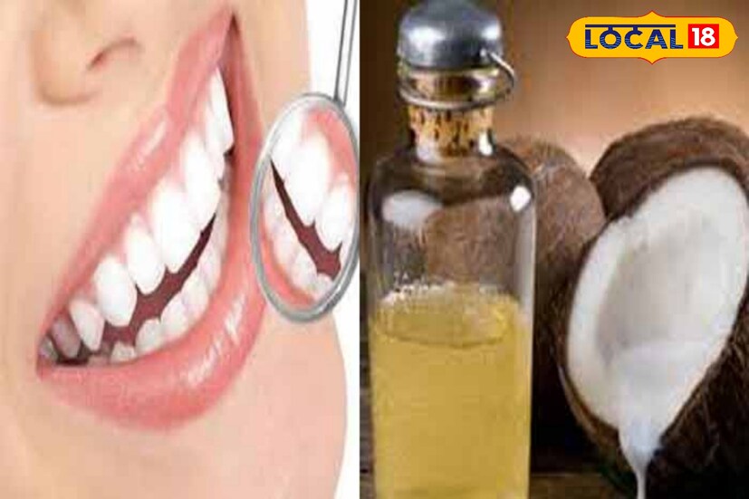 নারকেল তেল আপনার মুখের ক্ষতিকারক ব্যাকটেরিয়া আক্রমণ করে। এটি প্লাক তৈরি কমাতে পারে, দাঁতের ক্ষয় রোধ করতে পারে এবং মাড়ির রোগের বিরুদ্ধে লড়াই করতে পারে। নারকেল তেল আপনার মুখের ক্ষতিকারক ব্যাকটেরিয়া আক্রমণ করে। এটি প্লাক তৈরি কমাতে পারে, দাঁতের ক্ষয় রোধ করতে পারে এবং মাড়ির রোগের বিরুদ্ধে লড়াই করতে পারে।