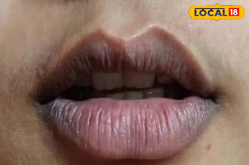 চিকিৎসক সাহেব আলি জানান, অতিরিক্ত ধূমপান করলে অনেক সময় ঠোঁটে কালচে ছোপ পড়ে। দাঁত, মাড়ির সমস্যা হলেও ঠোঁট কালো হয়ে যায়।