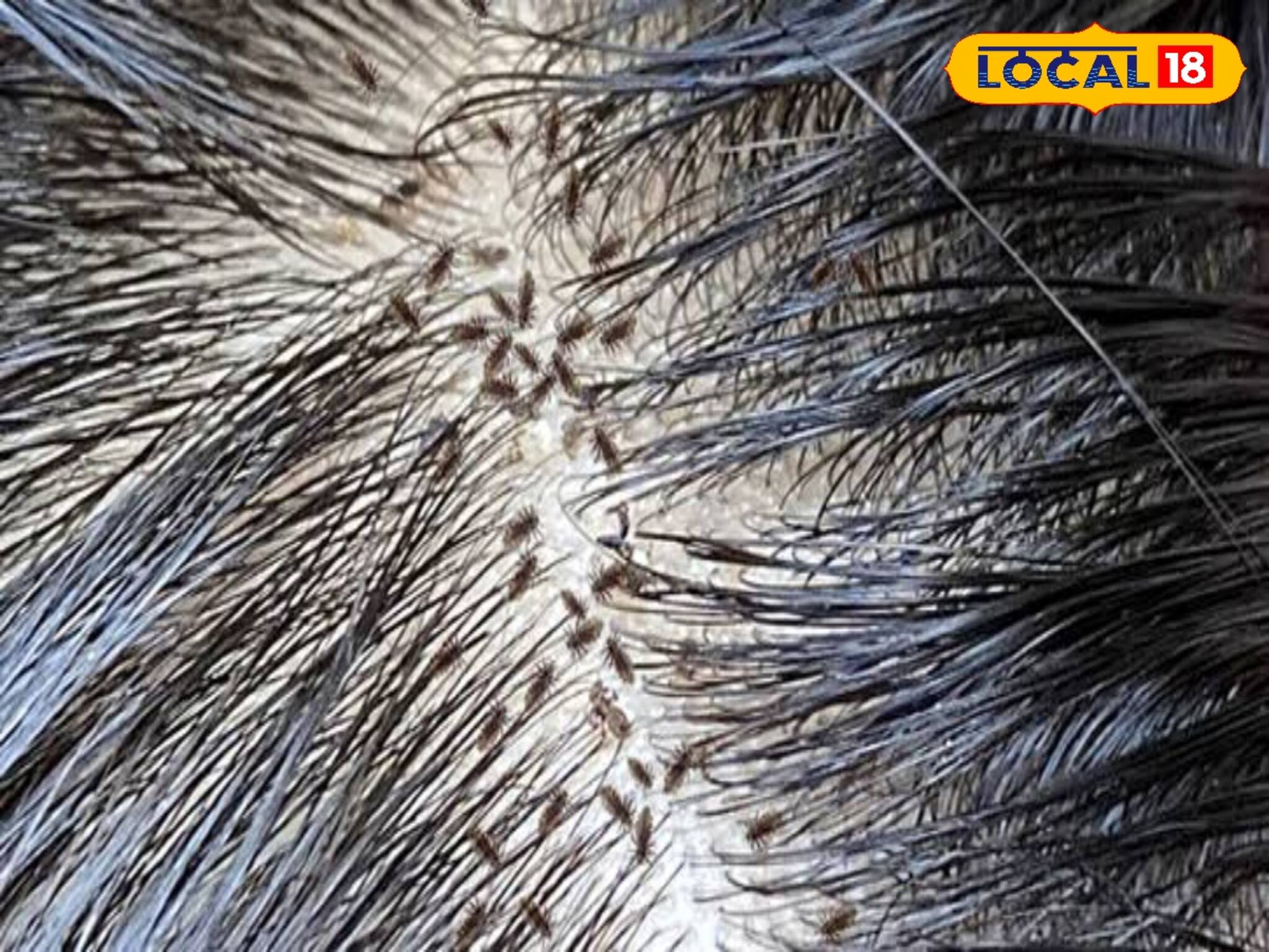 উকুন দূর হবে রাতারাতি! ক্ষতি হবে না চুলের! চিকিৎসকের থেকে জানুন বিশেষ টিপস