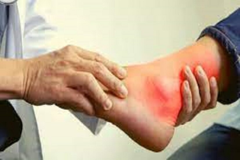 যখন ইউরিক অ্যাসিড বেশি জমা হয়, তখন ত্বকের নিচে টফাস নামে একটি ফোলা সৃষ্টি হয়। এটি অবহেলা করলে হাড়ের চলাচল ক্ষতিগ্রস্ত হতে পারে এবং অন্যান্য সমস্যা দেখা দিতে পারে।