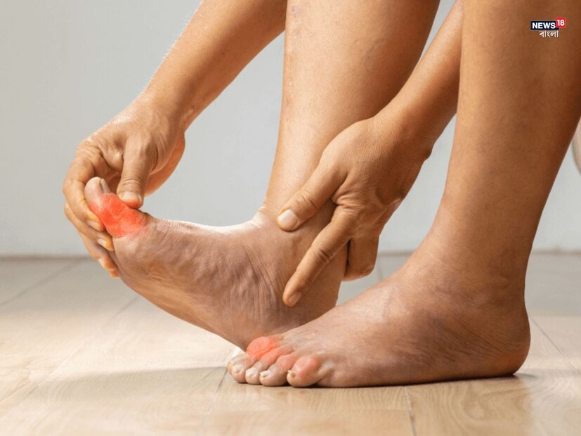 ভুল লাইফস্টাইল এবং খাদ্যাভ্যাসের কারণে অনেকেই উচ্চ ইউরিক অ্যাসিডের সমস্যায় ভুগছেন, যা বাত এবং কিডনির সমস্যা তৈরি করে। যাইহোক, এই সমস্যা মোকাবেলা করার জন্য অনেক প্রাকৃতিক প্রতিকার পাওয়া যায়। আয়ুর্বেদ এবং ঐতিহ্যগত চিকিৎসা ব্যবস্থায়, মশলাকে ইউরিক অ্যাসিড কমাতে একটি কার্যকর প্রতিকার হিসেবে বিবেচনা করা হয়।