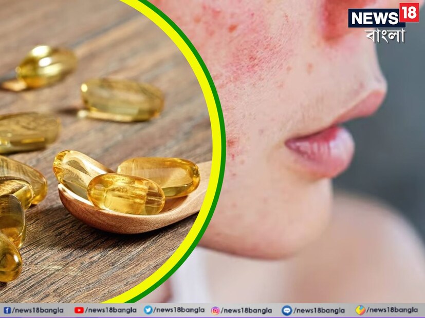 ত্বকে যে নাছোড় ব্রণ, ফুসকুড়ি বা র‌্যাশের সমস্যা নিয়ে হিমশিম খাচ্ছেন, তার নেপথ্যেও নাকি আছে ওমেগা ৩ ফ্যাটি অ্যাসিডই। এমনই দাবি করা হয়েছে এক গবেষণায়।