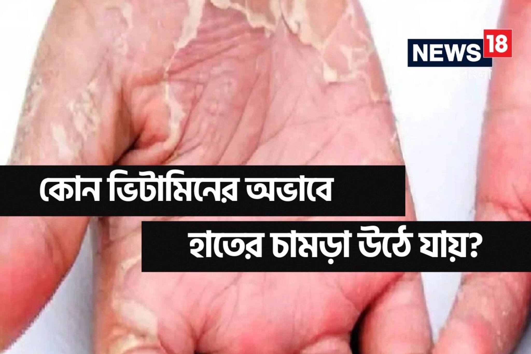 হাতে-পায়ে ছাল উঠছে? শরীরে কিসের অভাব দেখা দিয়েছে জানেন? এখনই সাবধান হন