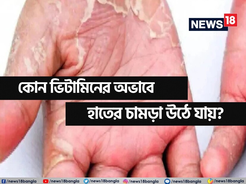 শীতকালে হাত-পায়ের চামড়া ওঠে অনেকেরই। তবে, জানেন কি, সারা বছর ধরেই যদি হাত-পায়ের খোসা উঠতে দেখা যায়, সেটি দুশ্চিন্তার কারণ হতে পারে!  কোন ভিটামিনের অভাবে এমনটা হয়? জানলে চমকে যাবেন। যত্ন নেবেন আপনিও। 