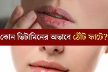 বলুন তো শরীরে কোন ভিটামিনের অভাবে ঠোঁট ফাটে? সব দোষ শীতের নয় কিন্তু...