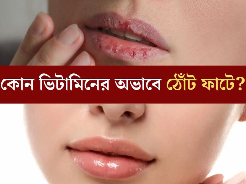 শীতকাল মানেই ফাটা ঠোঁট, ফাটা গোড়ালি, শুষ্ক ত্বক। বিশেষত ঠোঁট ফেটে যাওয়ার সমস&#x200d;্যায় ভোগেন প্রচুর মানুষ। এক্ষেত্রে বেশিরভাগ সকলেই দোষারোপ করেন ঠান্ডার শুষ্ক আবহাওয়াকে। কিন্তু জানেন কি শরীরে একটি নির্দিষ্ট ভিটামিনের অভাবের কারণেও এই সমস্যা হতে পারে।