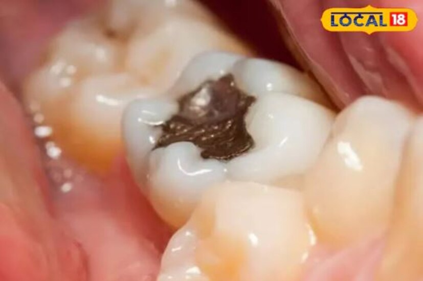 দাঁতে পোকা। সাধারণত সমস্যা, তবে বেশিরভাগ মানুষেরই ঘটে। দাঁতের পোকা দূর করতে সর্ষের তেলে হলুদ গুঁড়ো ও নুন মিশিয়ে নিন। একটি পেস্ট প্রস্তুত করতে হবে। তারপর পেস্টটি ব্রাশ দিয়ে ব্যথার স্থানে লাগাতে হবে।