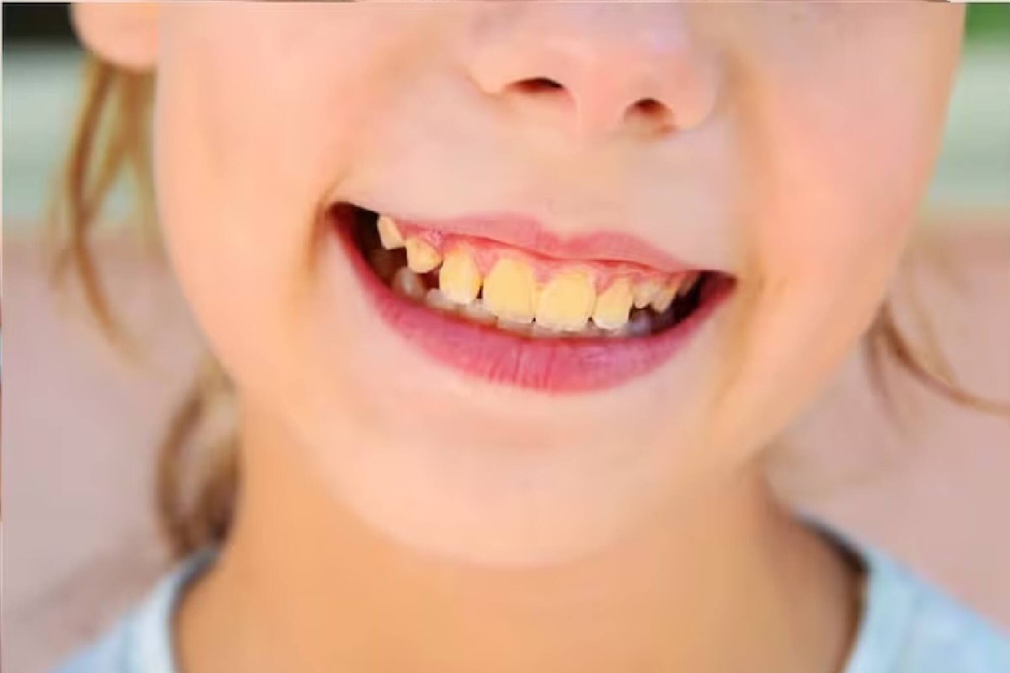 রান্নাঘরের এই জিনিস আপনার হলুদ দাঁতকে করবে মুক্তোর মতো উজ্জ্বল! মাত্র ৫ মিনিটে পান রেজাল্ট